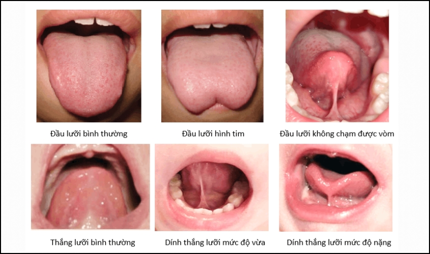 Dấu hiệu cần đưa trẻ đi khám nói ngọng